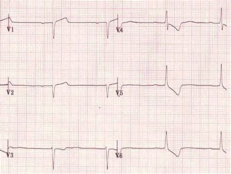 poor r wave progression in hindi|ECG interpretation in hindi .
